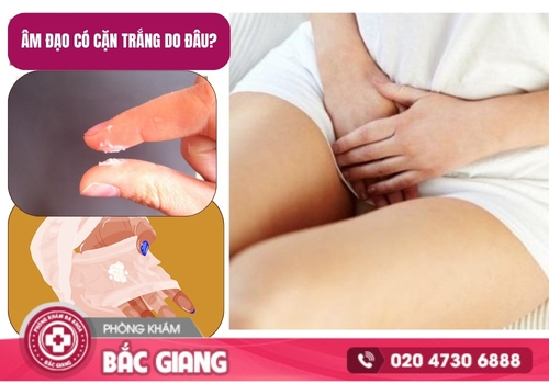 Âm đạo có cặn trắng là do đâu? Cách khắc phục hiệu quả