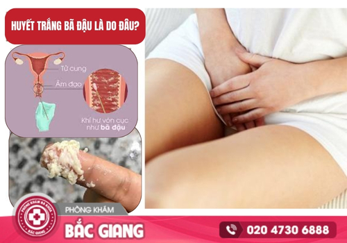 Nguyên nhân ra huyết trắng bã đậu và cách điều trị hiệu quả