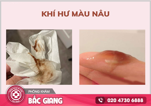 Ngứa vùng kín ra khí hư màu nâu do những nguyên nhân nào?