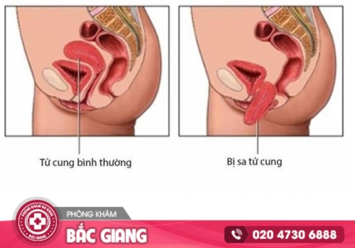 Bệnh phụ khoa âm thầm gây hại - Đừng chủ quan với dấu hiệu