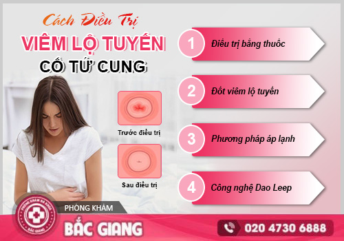 Đốt viêm lộ tuyến cổ tử cung: Quy trình, chi phí và địa chỉ uy tín