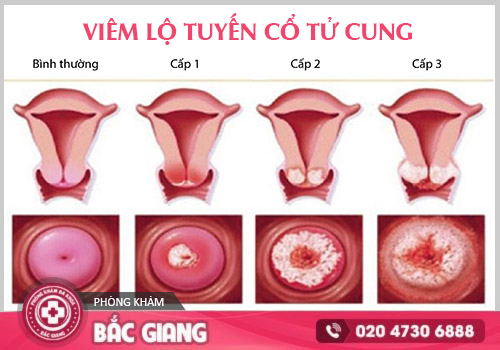 Đốt viêm lộ tuyến cổ tử cung: Quy trình, chi phí và địa chỉ uy tín